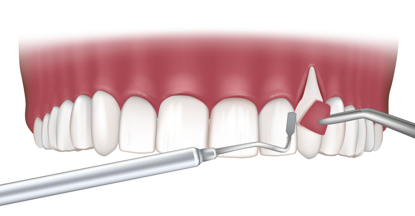 Featured image for the Benefits of the Pinhole Surgical Technique