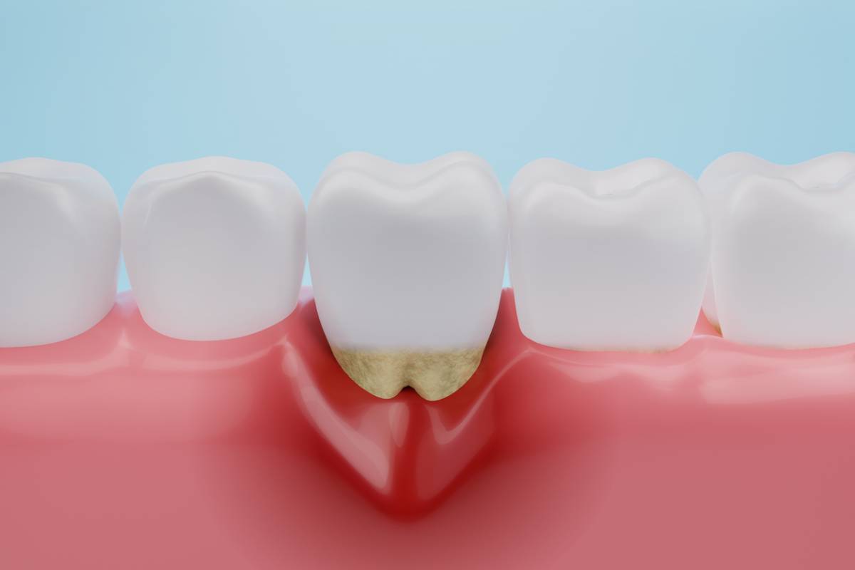 featured image showing key symptoms of gum disease