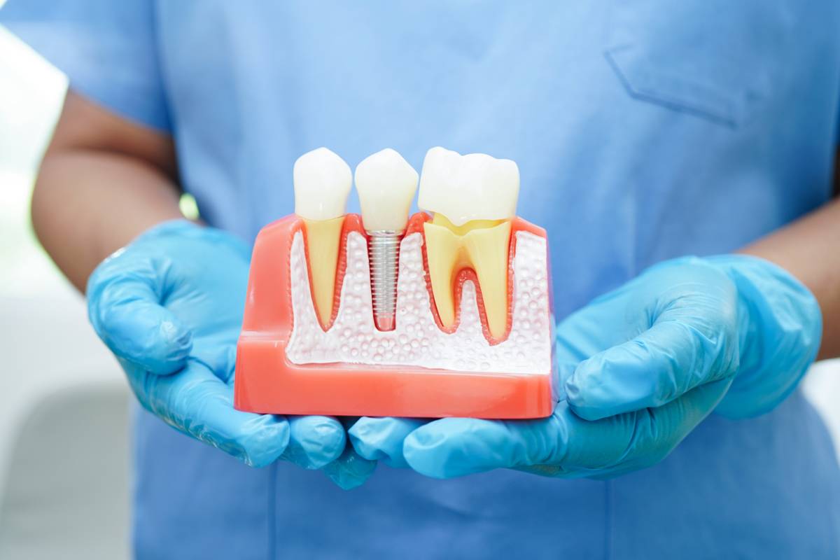 Featured image for Can a Periodontist Do Dental Implants