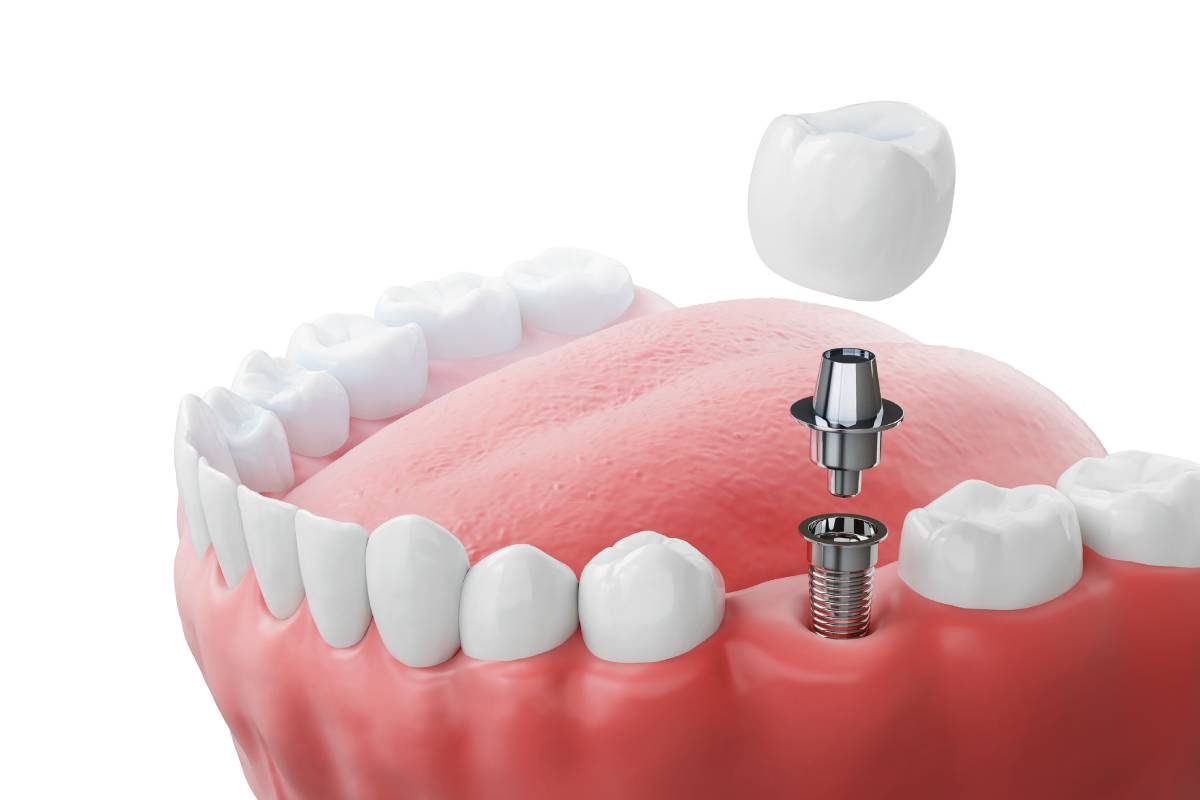 Featured image for How Long Do Dental Implants Last